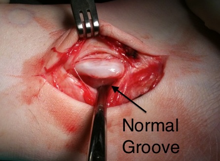 Normal Groove